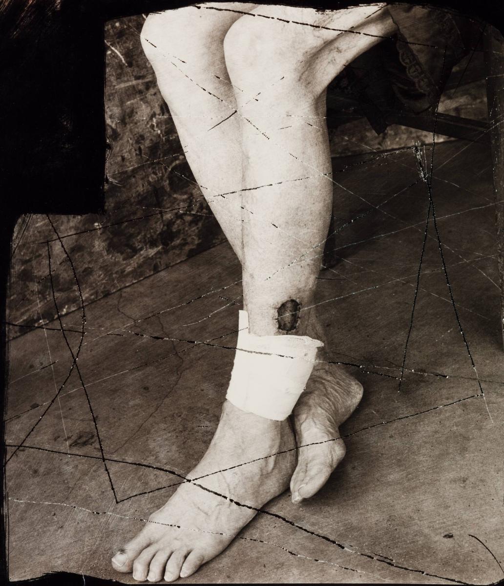 Leg with Wound