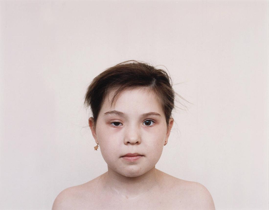 Children who have had a Thyroid Operation. From the Series Echo of Silence