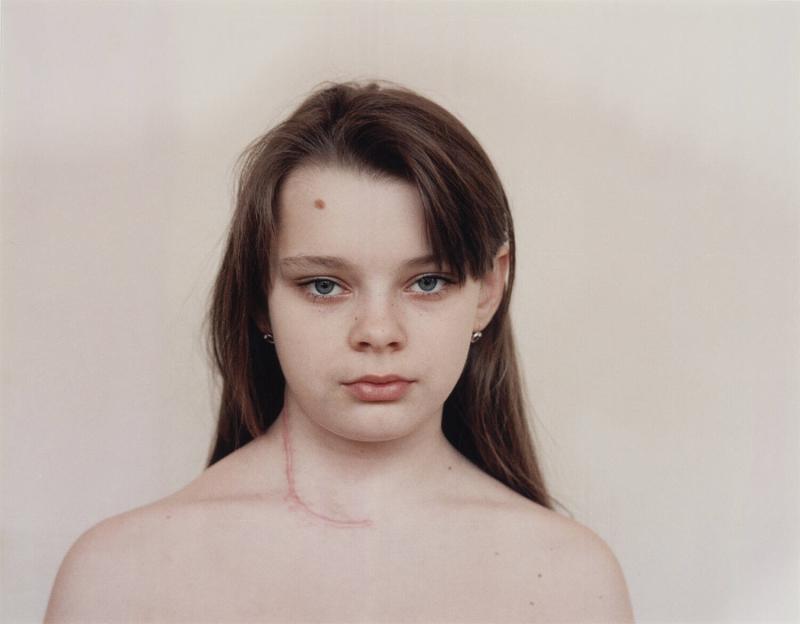 Children who have had a Thyroid Operation. From the Series Echo of Silence