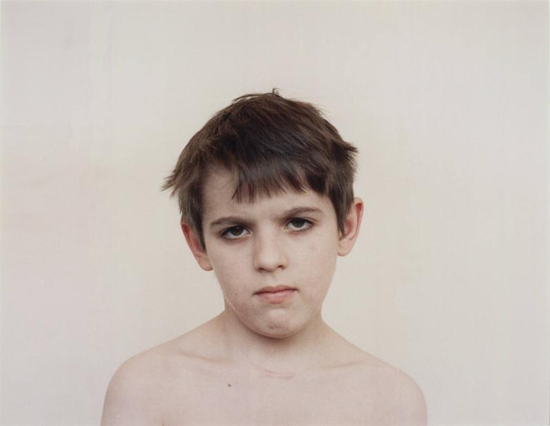Children who have had a Thyroid Operation. From the Series Echo of Silence