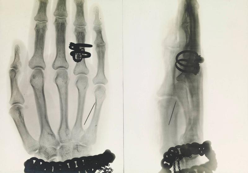 Röntgenbild. Synål i hand; i den öfre ringen en äkta pärla, i den nedre en äkta diamant